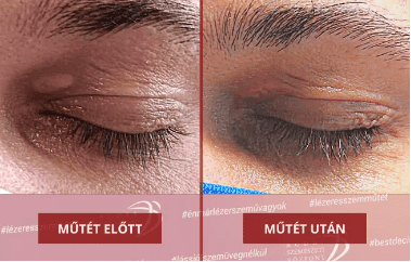 xanthelasma eltávolítás